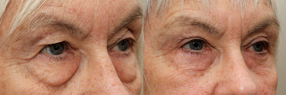 Upper Eyelid Patient 7 | Oasis Eye Face and Skin, Ashland, OR