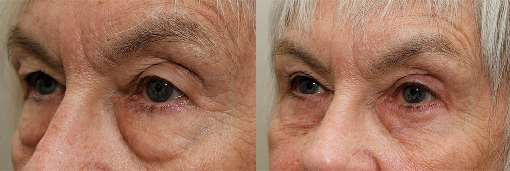 Upper Eyelid Patient 7 | Oasis Eye Face and Skin, Ashland, OR
