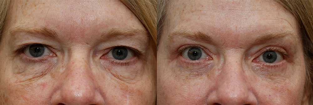 Upper Eyelid Patient 8 | Oasis Eye Face and Skin, Ashland, OR