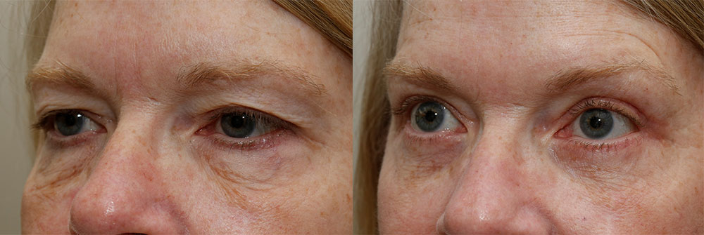 Upper Eyelid Patient 8 | Oasis Eye Face and Skin, Ashland, OR