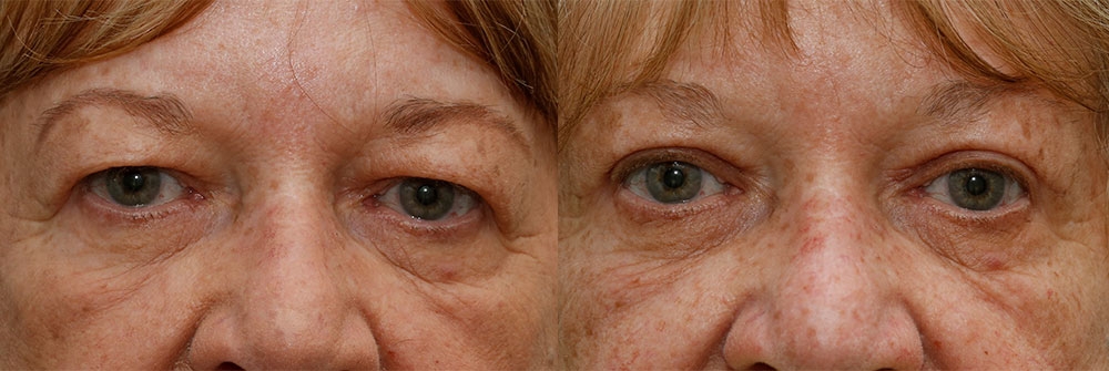 Upper Eyelid Patient 5 | Oasis Eye Face and Skin, Ashland, OR