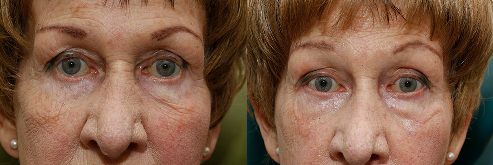 Retraction Repair Patient 10 | Oasis Eye Face and Skin, Ashland, OR