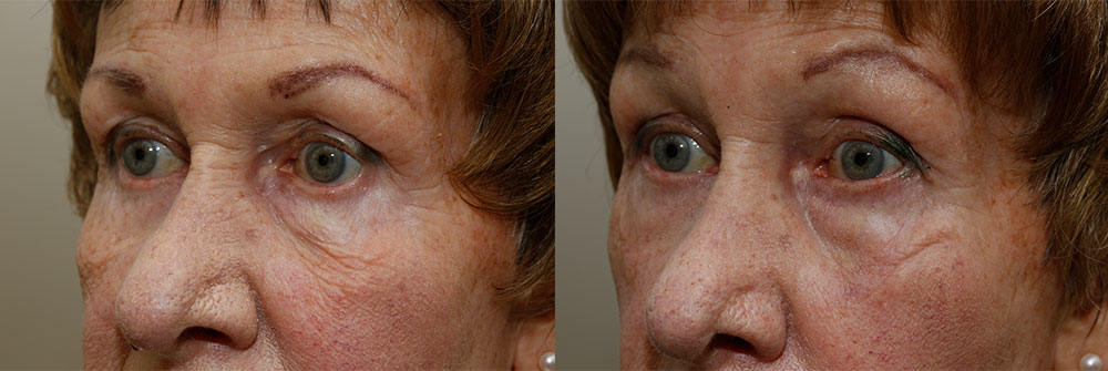 Retraction Repair Patient 10 | Oasis Eye Face and Skin, Ashland, OR