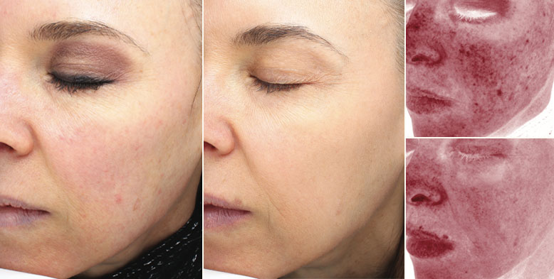 Halo Treatment Photos | Oasis Eye Face and Skin, Ashland, OR