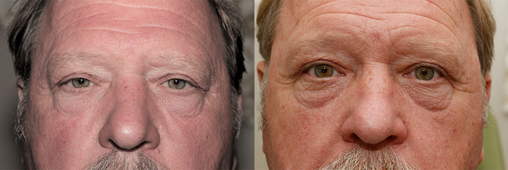 Oasis Eyelid Patient13a Oasis Eye Face and Skin