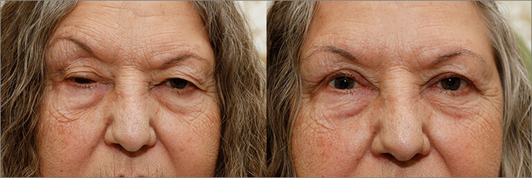 Oasis Eyelid Patient14a 1 1 Oasis Eye Face and Skin