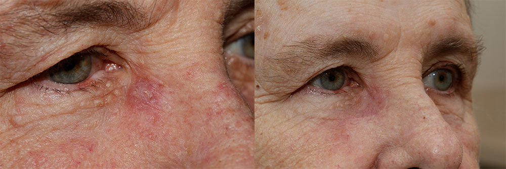 Oasis Eyelid Patient16a Oasis Eye Face and Skin