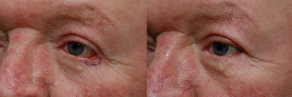 Oasis Eyelid Patient17a Oasis Eye Face and Skin