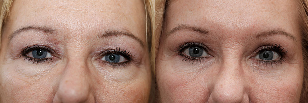 Oasis Eyelid Patient21a Oasis Eye Face and Skin