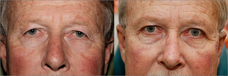 Oasis Eyelid Patient3a 1 1 Oasis Eye Face and Skin