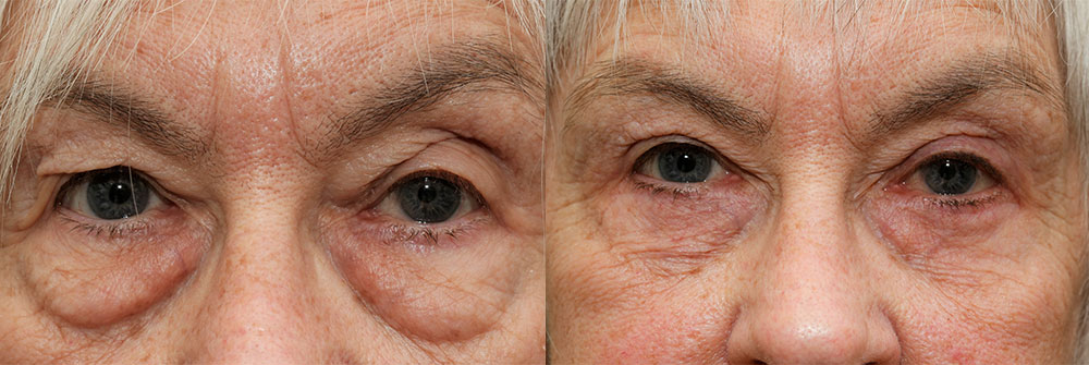 Oasis Eyelid Patient7a Oasis Eye Face and Skin