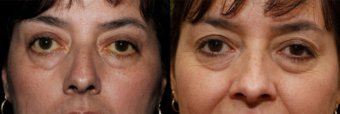 Oasis Retraction Patient11a 700x235 1 Oasis Eye Face and Skin