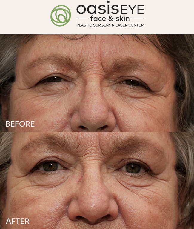 ptosis-repair-pt-15a-min
