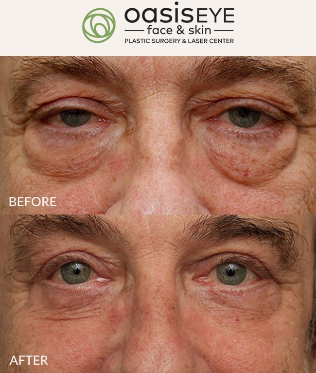 ptosis-repair-pt-30c-min