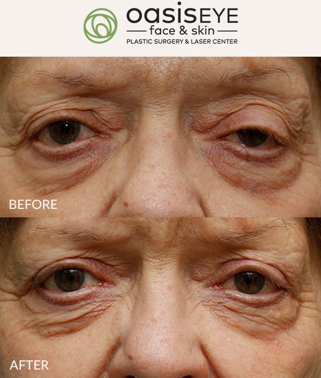 ptosis-repair-pt-35a-min
