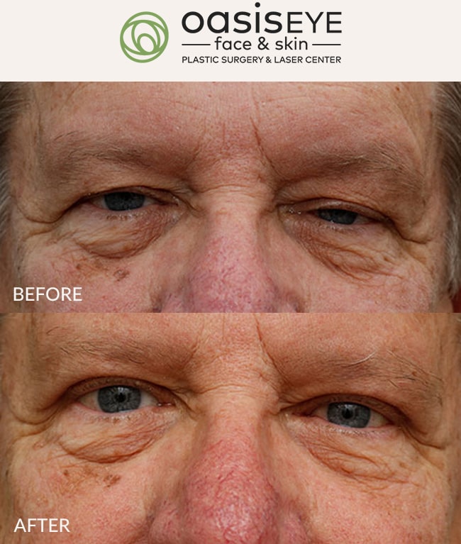 ptosis-repair-pt-39c-min