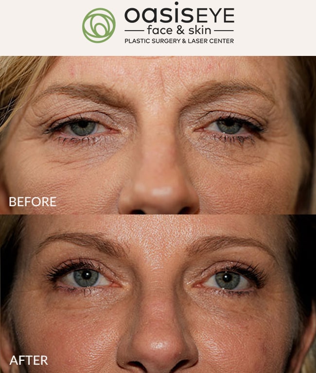 upper-eyelid-pt-19c-min