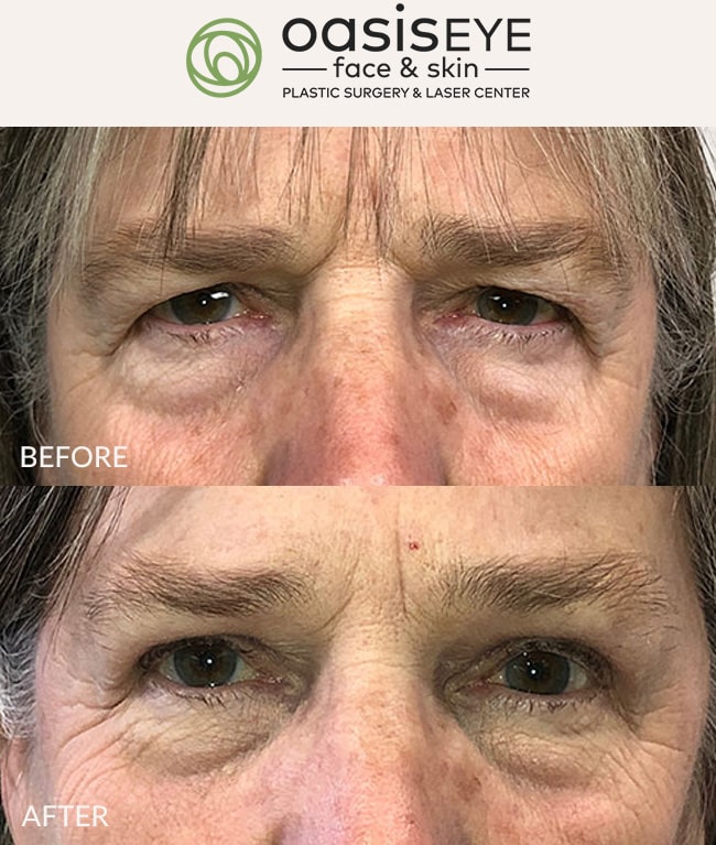 upper-eyelid-pt-33-min
