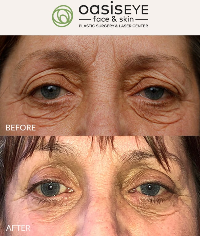 upper-eyelid-pt-34-min