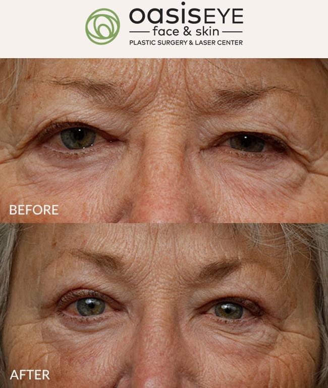 upper-eyelid-pt-47c-min