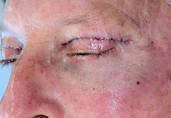 Upper & Lower Blepharoplasty with Laser Image
