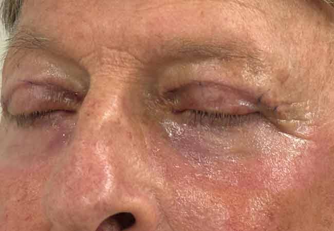 Upper & Lower Blepharoplasty with Laser Image