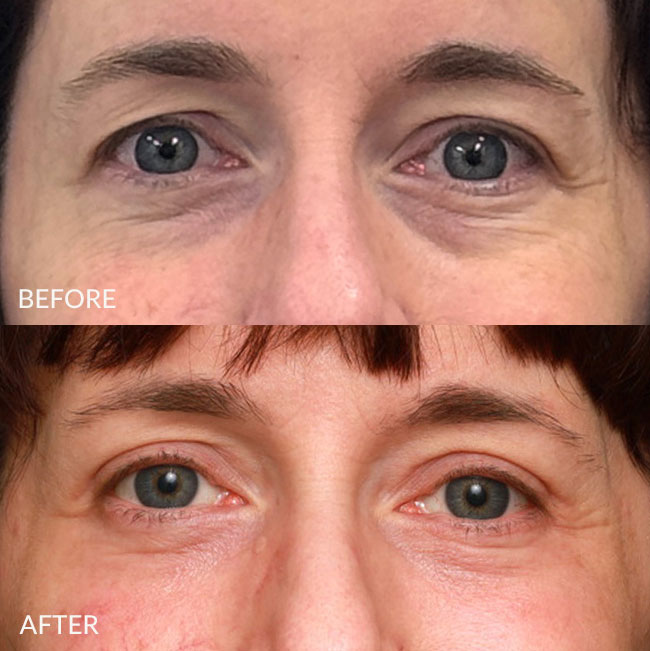 upper and lower bleph