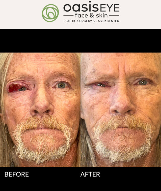 RUL SKIN CANCER male 61yo CM