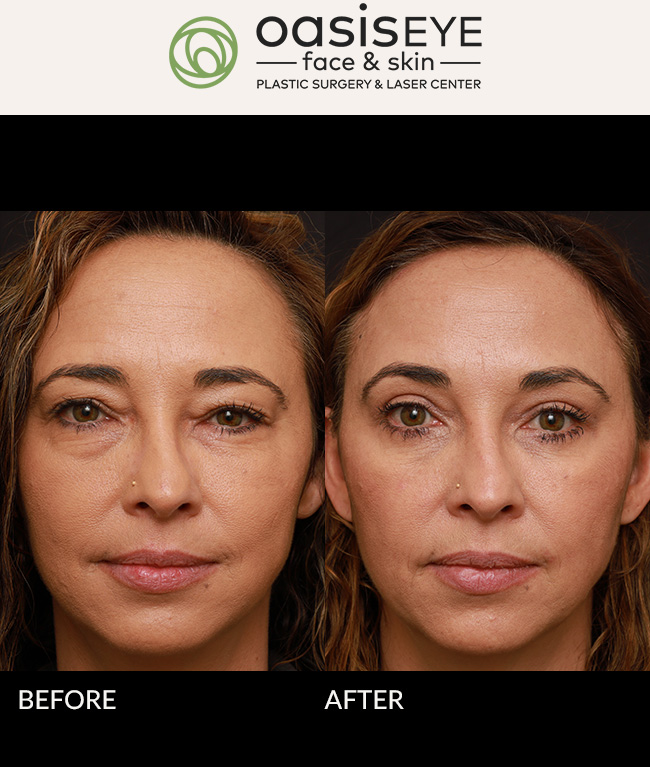 46 year old woman with very puffy eyes who felt she always looked swollen and her eyes were getting smaller over time. Allergy medications never helped the swelling around her eyes. She used to use a lot of makeup to camouflage the dark circles and puffiness. Dr. Schiedler did an upper blepharoplasty with fat removal, lower blepharoplasty with fat removal, and subcutaneous lateral hairline browlift in order to open up her eyes. She is thrilled with her dramatic improvement and natural results, and now uses almost no makeup on her eyes. Her friends and family have commented on how great she looks and her confidence has skyrocketed. Her eyes look a lot more open and bigger. Post op photos are at 4 months. Close up - healing hairline browlift incisions at 4 months. Almost completely faded.