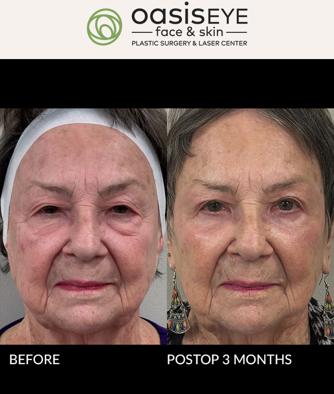 This 84 year old was bothered by very tired hooded eyes, bags and dark circles, and loose skin around her eyes. Dr. Schiedler did an upper blepharoplasty, lower blepharoplasty, and Oasis Peel on her periocular skin to tighten and reduce fine lines and wrinkles. There is some light pinkness from the peel at 3 months of healing. She already looks more awake and energetic. All pinkness is gone at 1 year 3 months, and she looks so refreshed and natural.