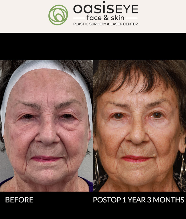 This 84 year old was bothered by very tired hooded eyes, bags and dark circles, and loose skin around her eyes. Dr. Schiedler did an upper blepharoplasty, lower blepharoplasty, and Oasis Peel on her periocular skin to tighten and reduce fine lines and wrinkles. There is some light pinkness from the peel at 3 months of healing. She already looks more awake and energetic. All pinkness is gone at 1 year 3 months, and she looks so refreshed and natural.