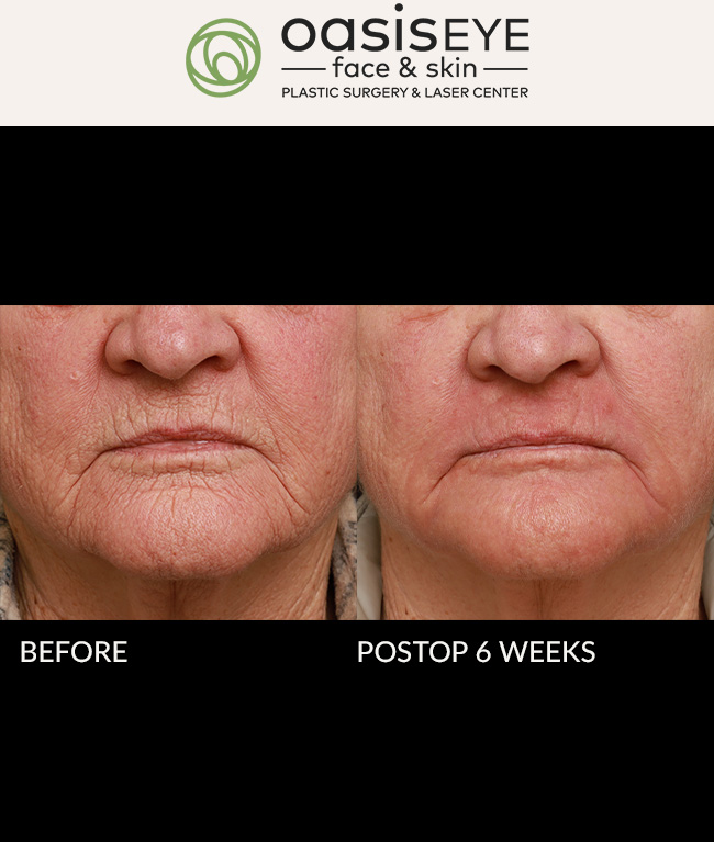 68 year old woman with very deep grooved wrinkles around her mouth underwent a deep chemical peel ( our Oasis Peel with croton oil and phenol ) to build collagen and improve texture and reduce the wrinkles. She was very happy with the improvement seen at 6 weeks. Healing….. One week of yellow bismuth paste on the skin, allowing it to crumble off and applying anti-microbial balm to the fresh new skin as it shows up. Very important to prepare the skin for this deep peel for 8 weeks prior to the peel with retinol and pigment blockers and sunscreen with zinc. This is the gold standard for the thick skin of the perioral area. Deep chemical peels with croton oil and phenol work better than laser for the wrinkles around the mouth.