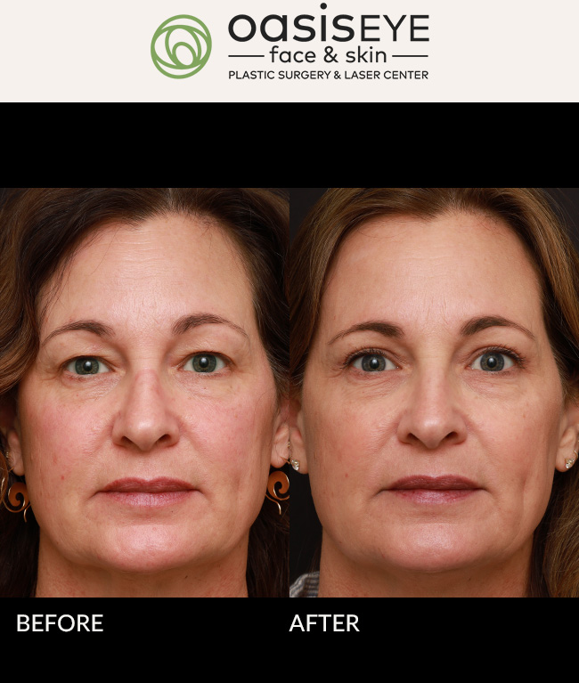 55 year old woman with tired hooded eyes. Dr. Schiedler did an upper blepharoplasty and now her eyes are vibrant, energetic, and no longer feel heavy and tired.