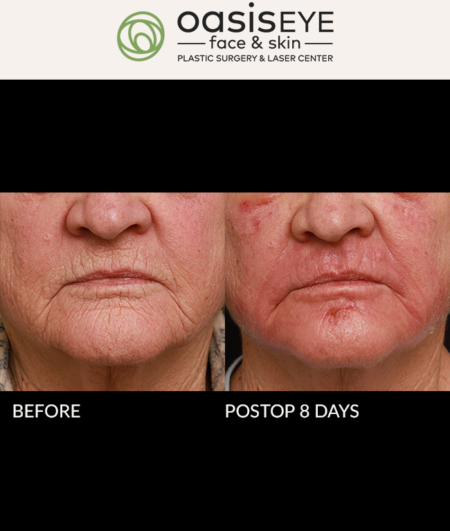 68 year old woman with very deep grooved wrinkles around her mouth underwent a deep chemical peel ( our Oasis Peel with croton oil and phenol ) to build collagen and improve texture and reduce the wrinkles. She was very happy with the improvement seen at 6 weeks. Healing….. One week of yellow bismuth paste on the skin, allowing it to crumble off and applying anti-microbial balm to the fresh new skin as it shows up. Very important to prepare the skin for this deep peel for 8 weeks prior to the peel with retinol and pigment blockers and sunscreen with zinc. This is the gold standard for the thick skin of the perioral area. Deep chemical peels with croton oil and phenol work better than laser for the wrinkles around the mouth.