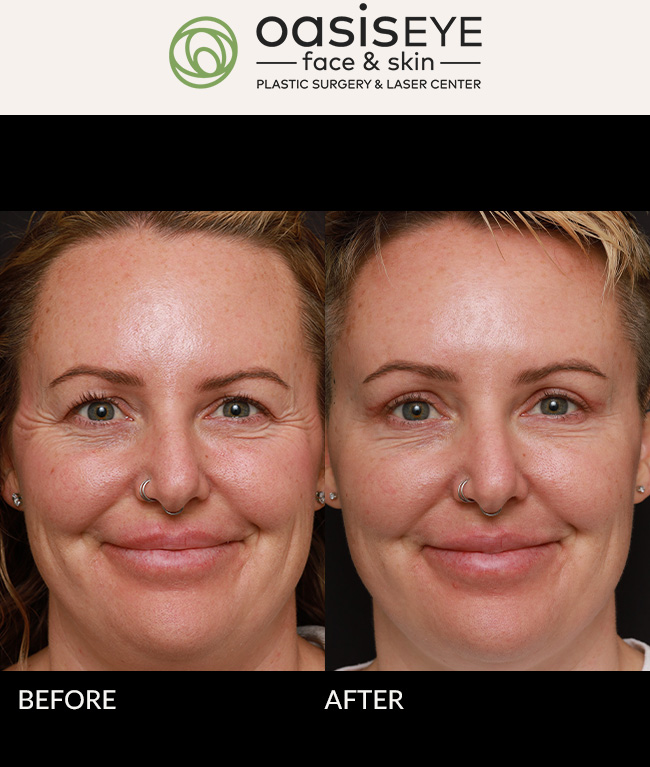 This 39 year old woman had an upper lid lift, or blepharoplasty, to alleviate her tired and heavy eyes. You can see the markings of the skin that was removed. Here she is at 6 weeks of healing with soft fading incisions that are well hidden in her natural crease, and a brighter more refreshed look.
