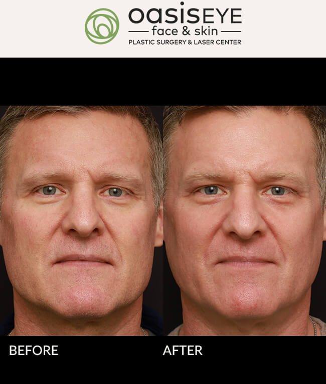 52 year old man wanted to improve his skin quality and remove mild sun damage. Dr.Schiedler did a full face CO2 laser which brightened his skin, tone, and texture. Note thebrightness of the skin after collagen built up around tiny blood vessels in the skin to reduceredness along cheeks and forehead.